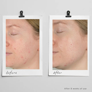 Acne-prone Balance Trio