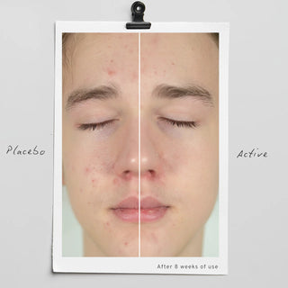 Acne-prone Balance Trio